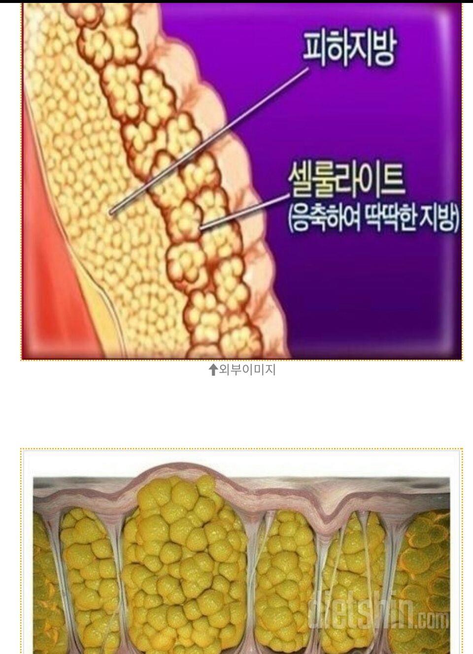 약혐)입맛 떨어지고 싶으신  분둘 보세요-셀룰라이트단면