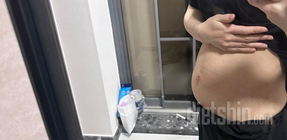 출산 후에 변비가 너무 심해져서 배가
