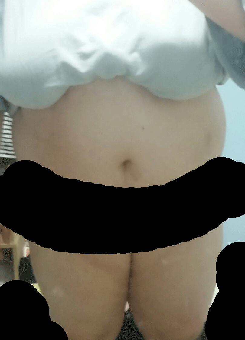 고도비만 탈출하고 싶어요!