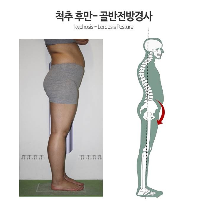 짝궁뎅이, 오리궁뎅이, 쳐진 힙…골반불균형 때문?