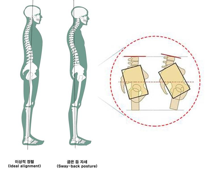 볼록 올라온 그곳, 치골 돌출 때문?