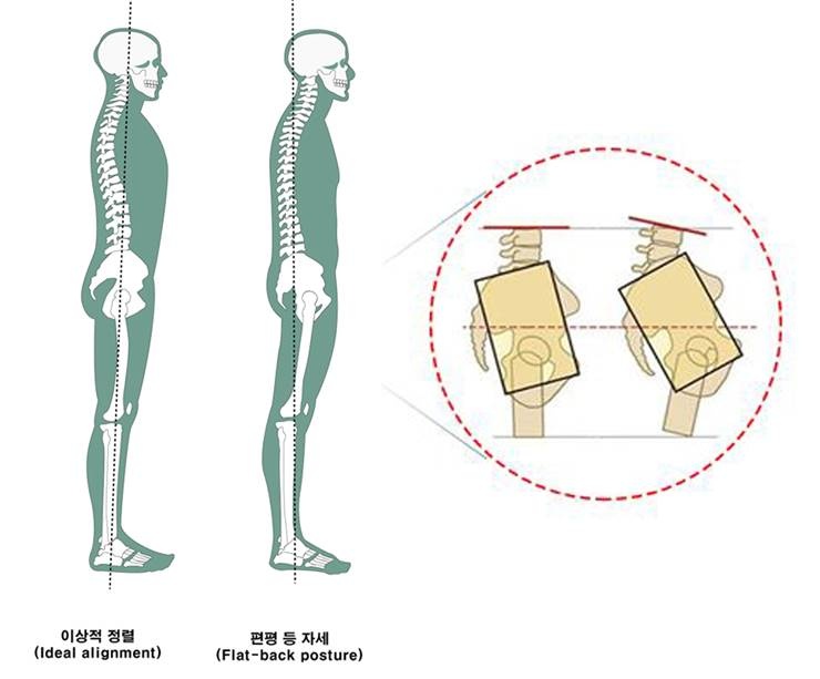 볼록 올라온 그곳, 치골 돌출 때문?