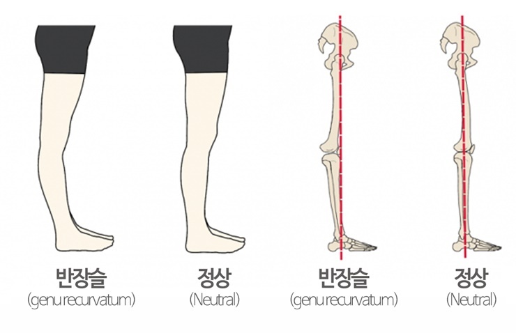 종아리 알, 잘 생기고 잘 붓는다면?