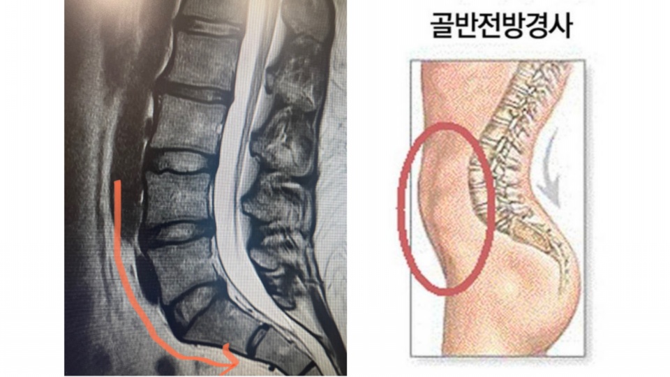 운동같이하는 동생이 허리가 계속 나가길래... 질문이요!!